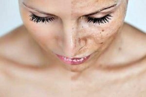 Usos del ácido tranexámico Melasma