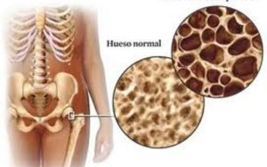 uso del ácido zoledrónico. Osteoporosis